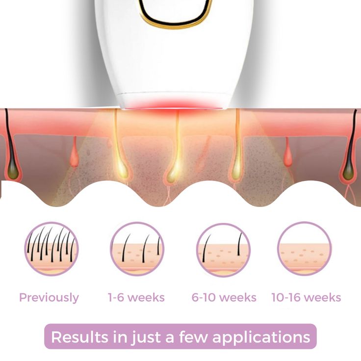 IPL Hair Removal Device – Portable IPL Hair Removal Instrument for Home Use